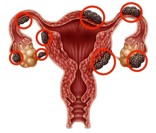 Lạc nội mạc tử cung gây ảnh hưởng đến khả năng sinh sản